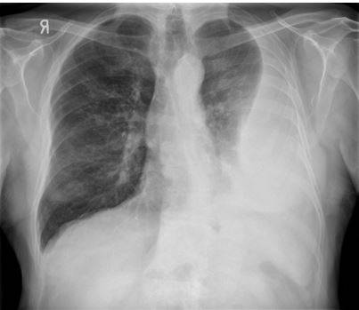 mesotelioma