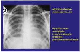 Alveolite allergica causata da muffa